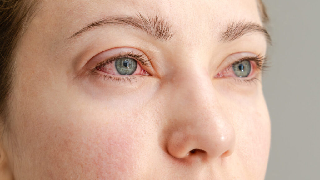 Closeup of woman's face who has red eyes