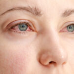 Closeup of woman's face who has red eyes