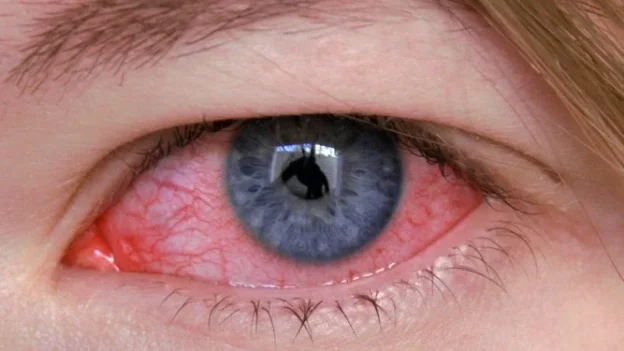 Pink Eye (Conjunctivitis): Symptoms, Treatment and Common Myths