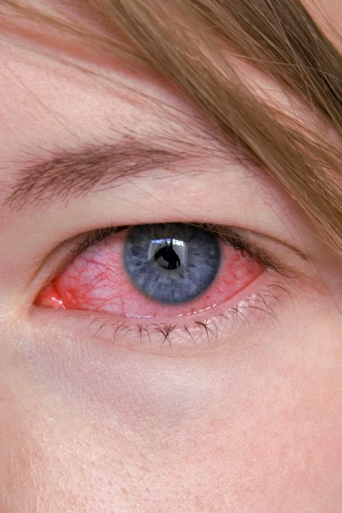 Conjunctivitis Explained