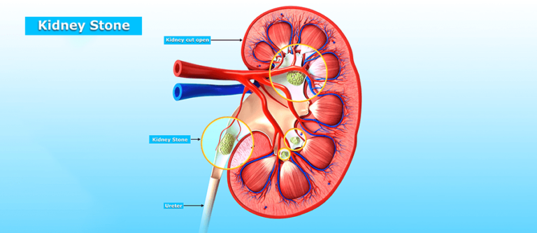 Kidney Stones (Nephrolithiasis)