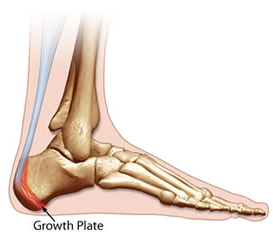 heel pain child athletes