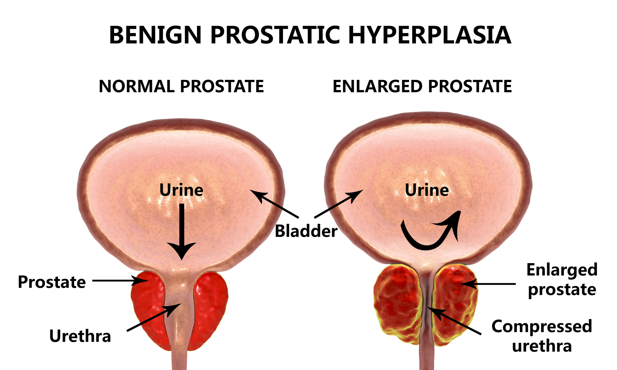 prostate stones natural treatment