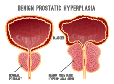 enlarged prostate at 40