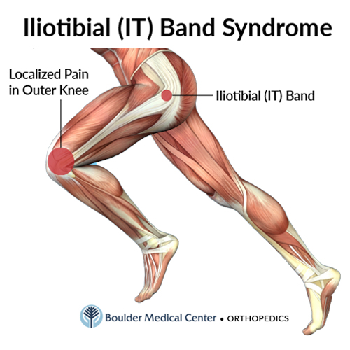 Iliotibial Band Friction Syndrome: Causes, Symptoms, Treatment and