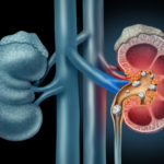 Title: Stephen Siegel, MD:  How to Prevent Another Kidney Stone