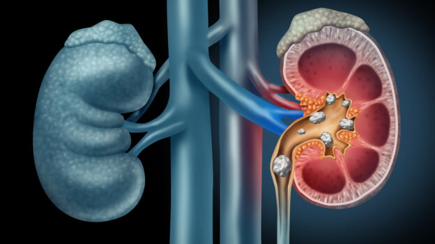 How to Prevent Kidney Stones