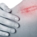 Person with hand on bare shoulder showing a red scar