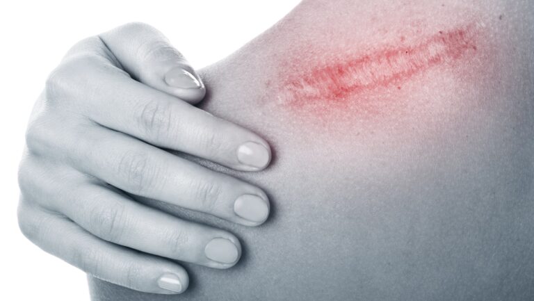 Scars – What to Expect, How to Improve Them