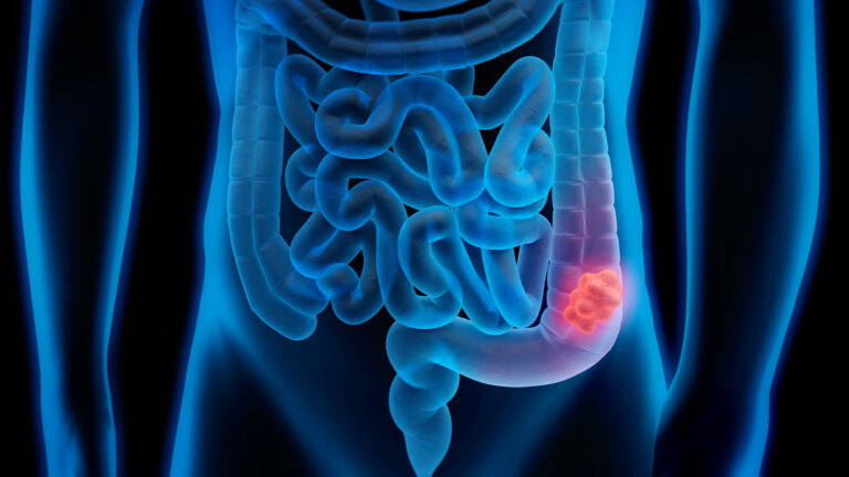Have Your Colonoscopy or Endoscopy at Boulder Medical Center