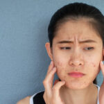 acne-treatment-longmont-boulder