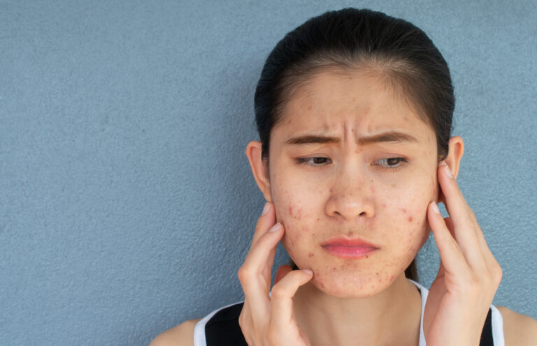 Teen Acne Survival Kit: A Guide for Clearer Skin