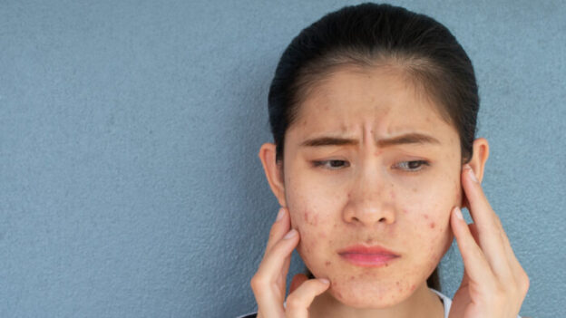 Teen Acne Survival Kit: A Guide for Clearer Skin