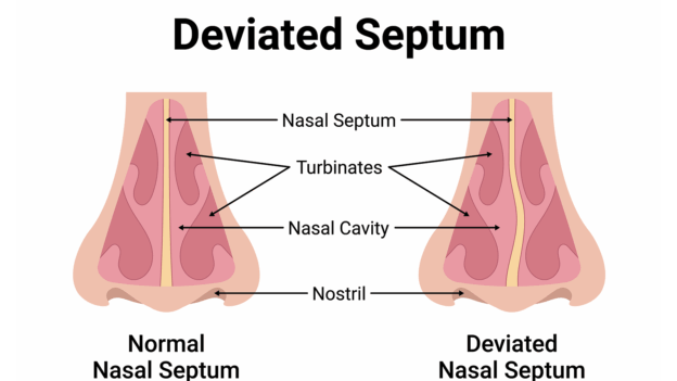Deviated Septum: Symptoms and Treatments