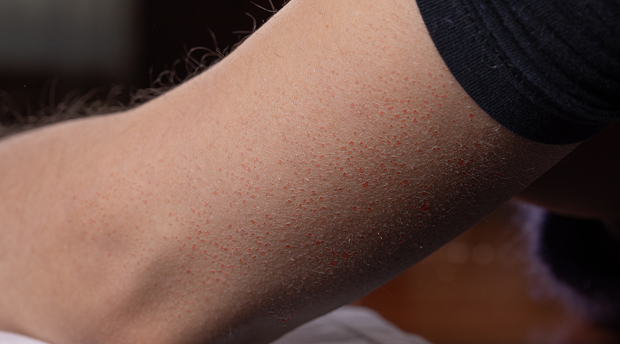 keratosis pilaris - dermatology - boulder medical center
