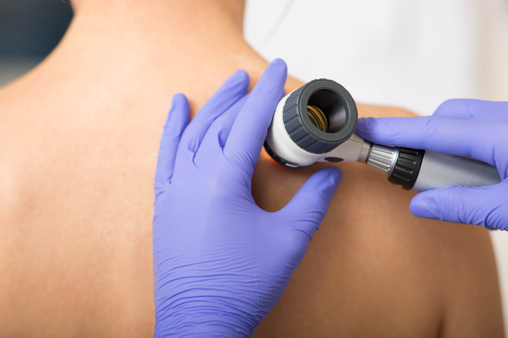 Same-Day Dermatology Appointments in Boulder: Rashes and Spots of Concern